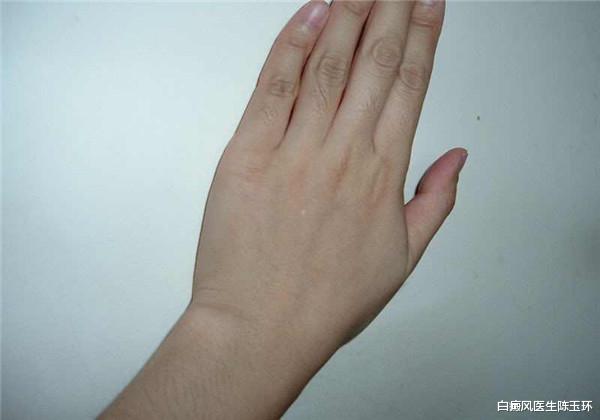 肝脏|白癜风饮食需要注意的三大事宜