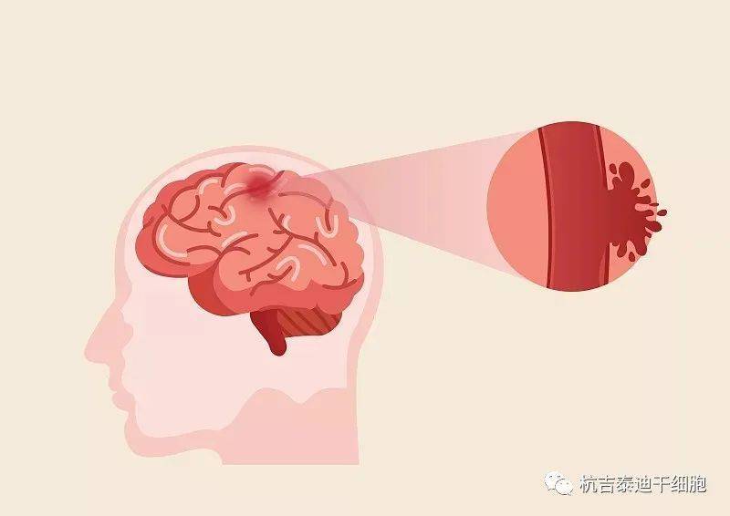 近年来干细胞治疗脑中风的临床进展怎么样