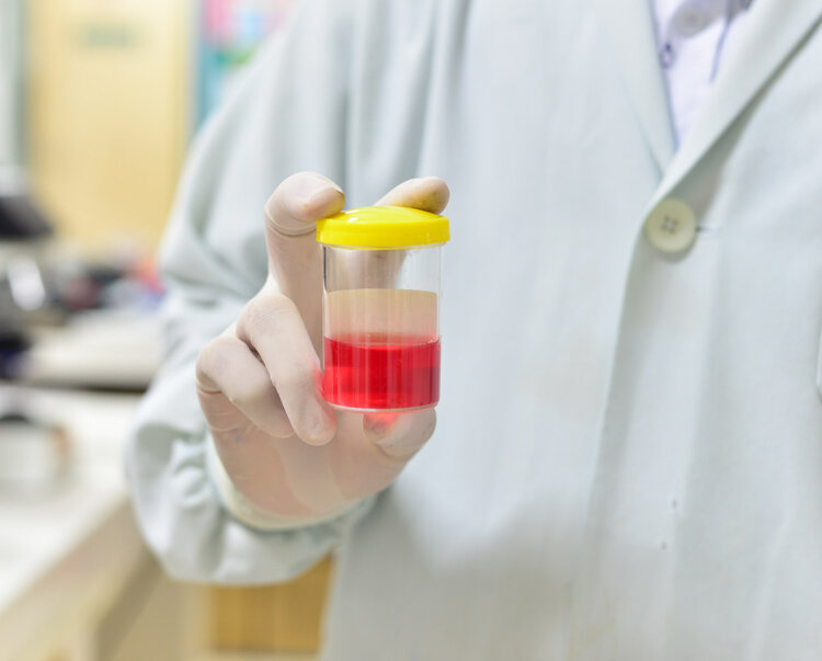 疾病|尿是人体晴雨表?提醒:尿液出现8种颜色异常,是身体在告密