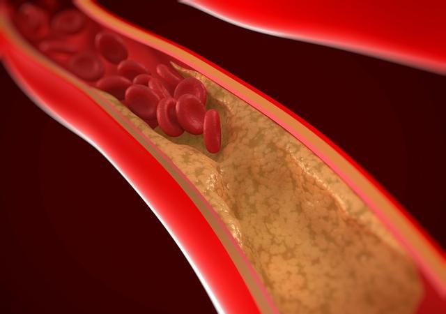 血栓|血管堵塞的人,早上起床会有4个表现,若占1个,最好检查一下!