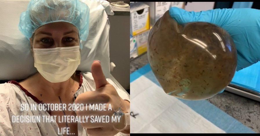 精神分裂症|美国一女子隆胸后怪病缠身 取出放18年“发霉腐烂”盐水袋才痊愈