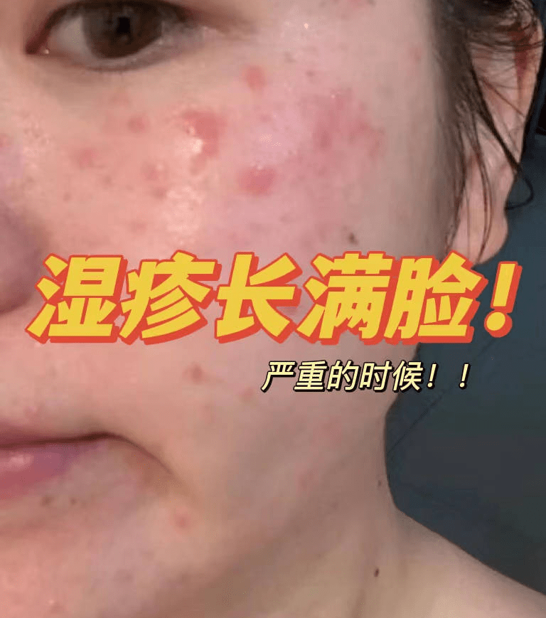排毒|白折腾了!后悔没有早点知道这个去湿止痒法!竟然7天就可搞定湿疹