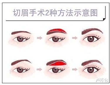 切口 做提眉可以提升额头吗？