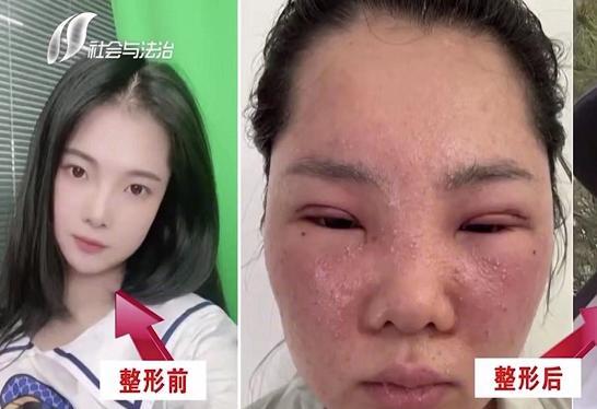 23岁妙龄女子割双眼皮变猪头,连母亲也认不出来,美容院拒绝赔偿