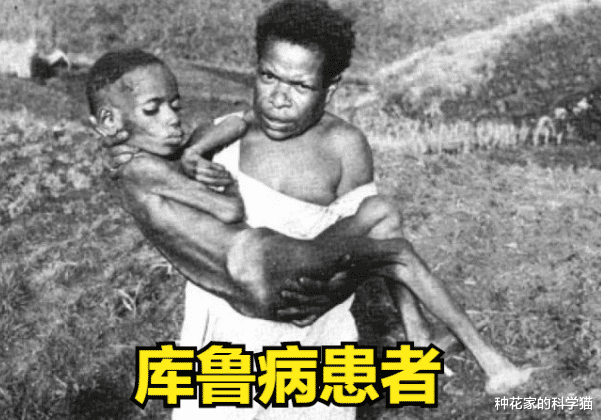 吃人肉会有什么样的后果?食人部落爆发库鲁病,死亡率高达100%