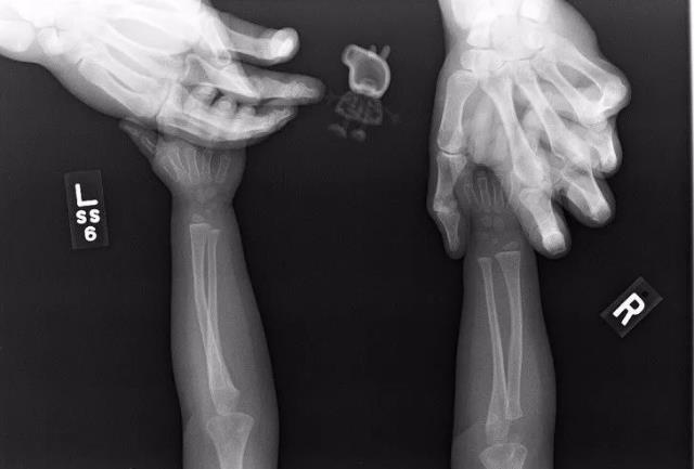 肺癌|盘点30张奇奇怪怪的X光片，看完整个人都不好了！