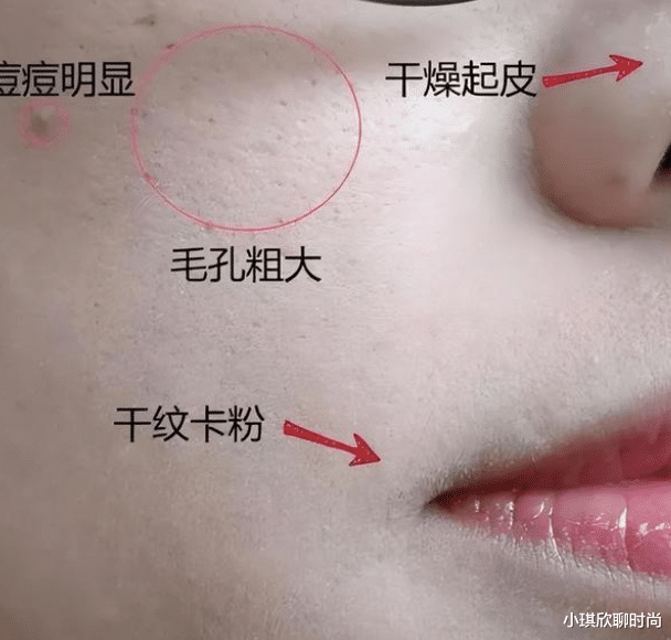 运动 毛孔粗大、黑头多该怎么办？没学会这些事情，涂再贵护肤品也没用