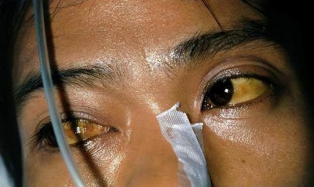 乙肝|乙肝“金字塔”，你在第几层？