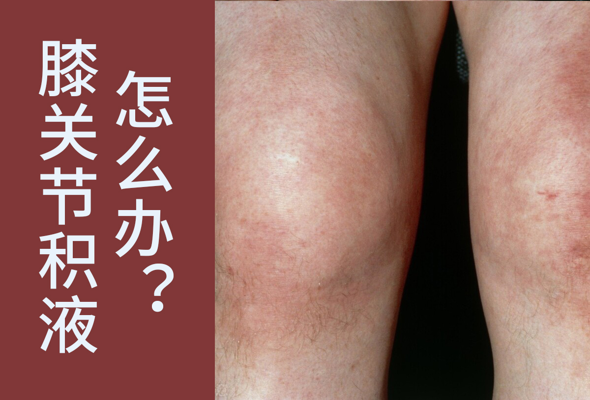 滑膜炎|得了滑膜炎应该怎么办？