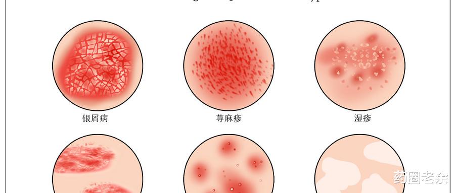 阑尾炎|牛皮癣防治,3个错误认知不能犯!
