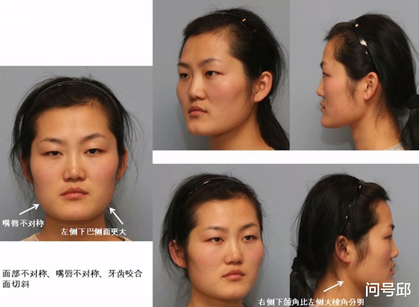 庄锶敏|刀锋下的“美丽”:带着美梦远赴韩国整容,最终毁容成了噩梦