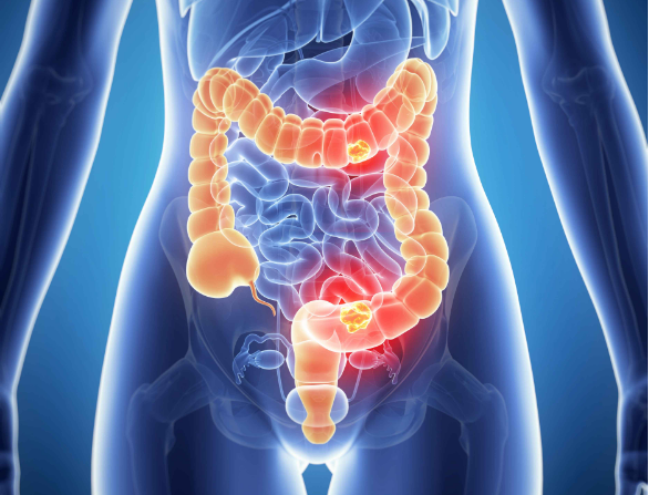 甲状腺结节|什么是肠易激?医生:绝对不要接触这些食物!