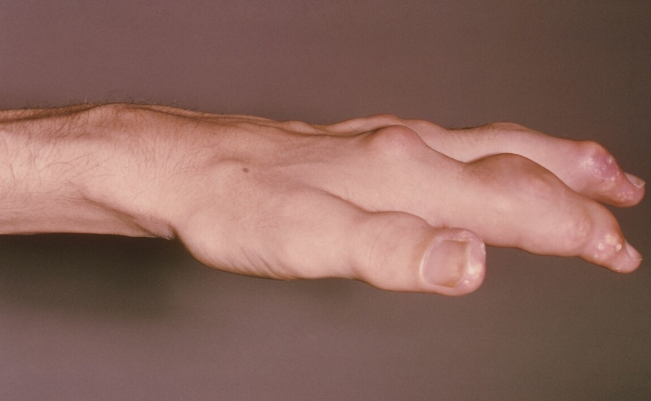 痛风|世界卫生组织公布:3种“假调料”,或是痛风“加速器”,转告家人