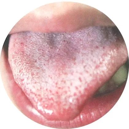 失眠|中医中的舌诊，了解吗