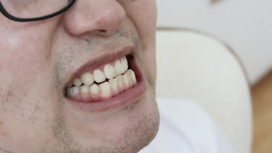 祖传秘方|人是什么时候开始“老掉牙”的？牙齿脱落后，老人需注意些什么？