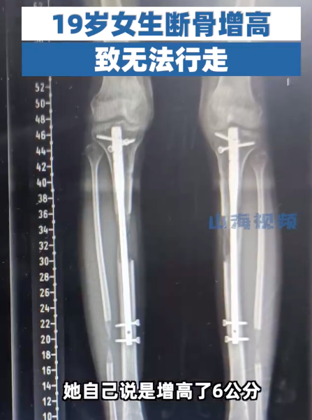 19岁女生觉得154cm太矮,断骨增高6厘米后无法行走,医生:极有可能残疾