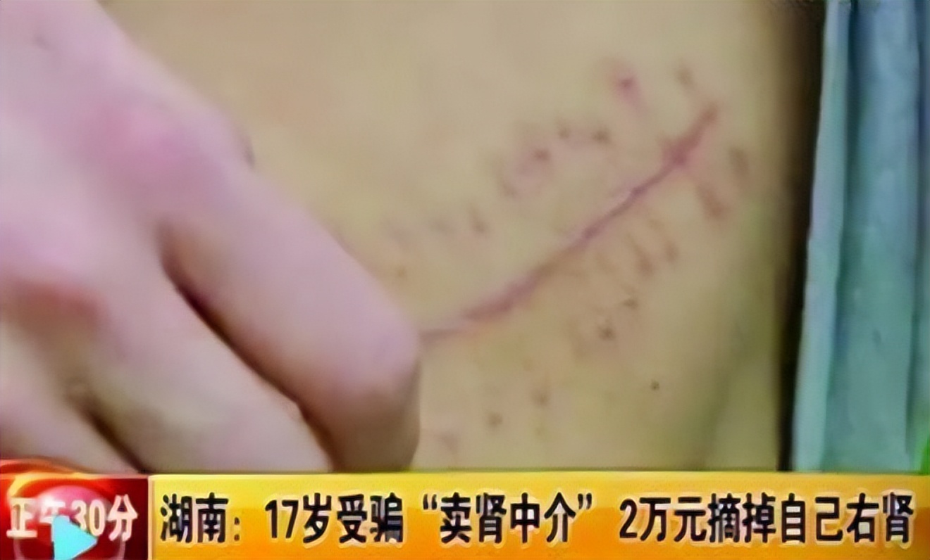 王刚|11年前,那个割肾买苹果手机的17岁小伙,拿到147万赔偿后咋样了