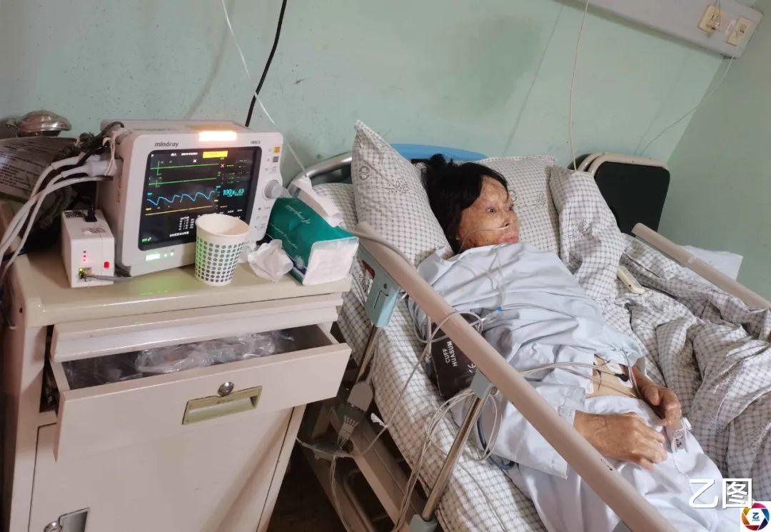 打工妹被女同事泼香蕉水点燃毁容,漂亮的模样如今成痛苦的记忆