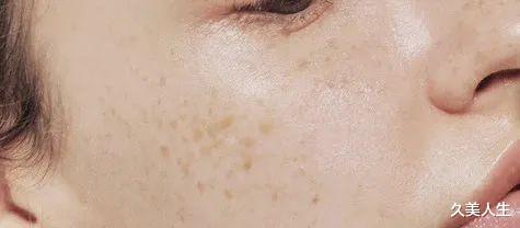 黑色素 去年美白又翻车了?点进来补课!