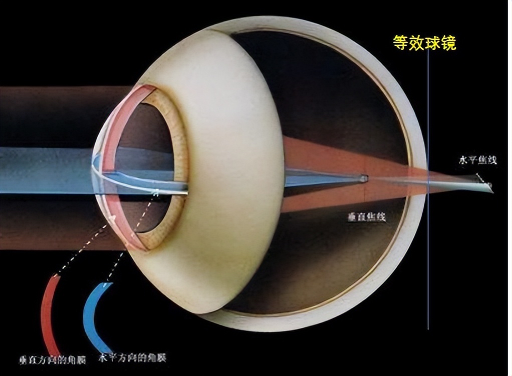 前列腺癌|《大国护眼之策》第二讲(1)近视的原因