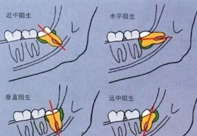 一夫一妻致自然选择失效,人类进化停止?研究:正在加速
