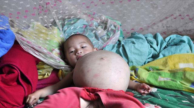 河南1岁半女童疑似怀孕,检查后在腹中发现胎儿,手术现场惊呆医生
