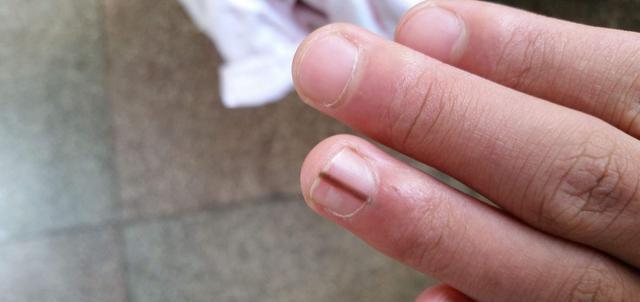 疾病 指甲出现的“竖纹”是什么?指甲常出现以下几个问题,建议看看