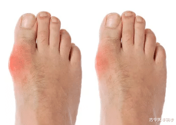 衰老|嘌呤“大户”被揪出，是海鲜10倍，医生坦言：再不戒掉，肾衰迟早上门