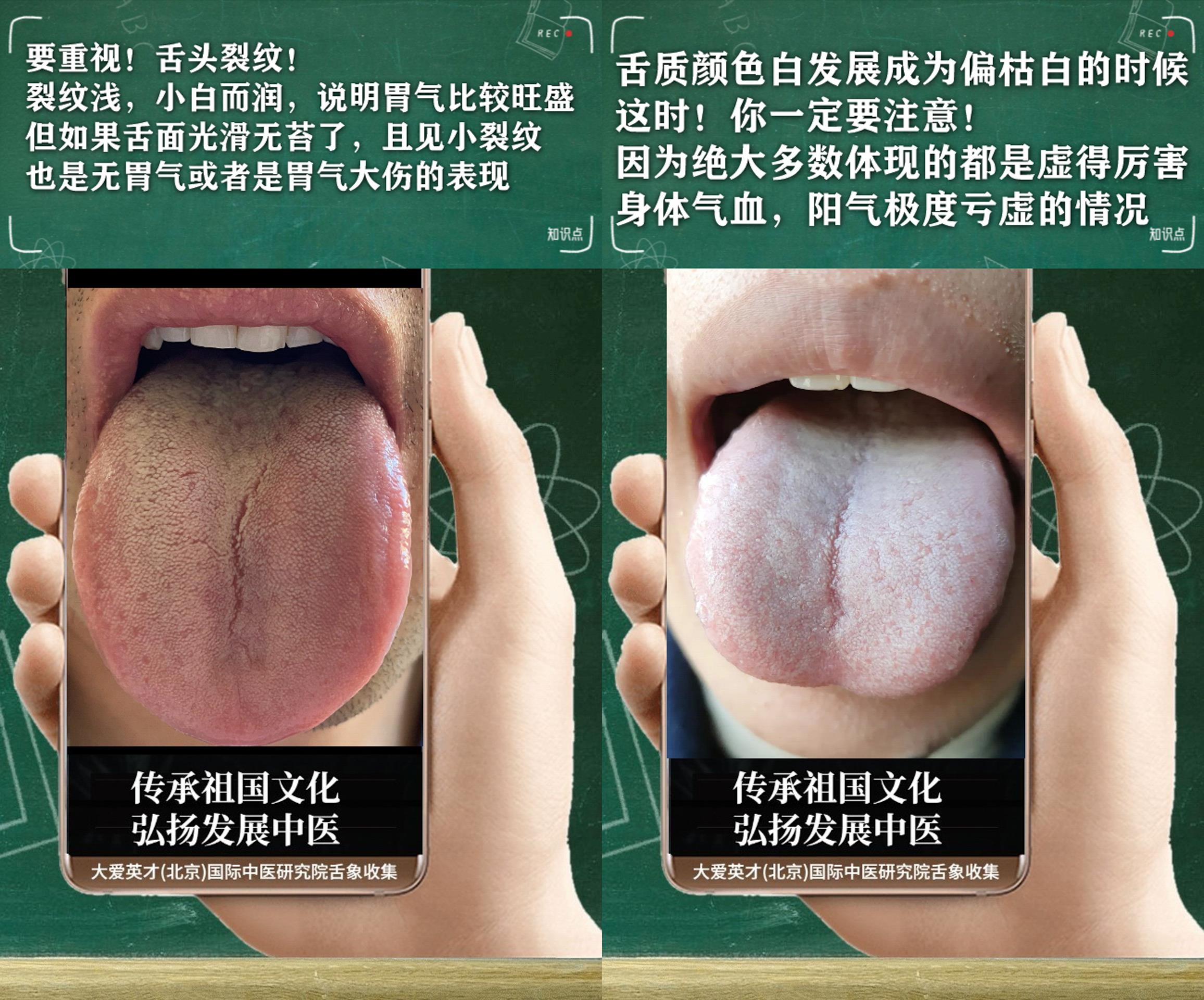 黄芪|中医病案：很抑欲，关节疼痛重，痰热互结，容易反复很不舒服