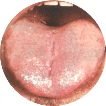 失眠|中医中的舌诊,了解吗