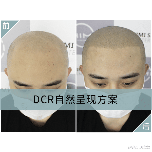 高血压|别说没提醒你,这些防脱方法基本上没什么用!