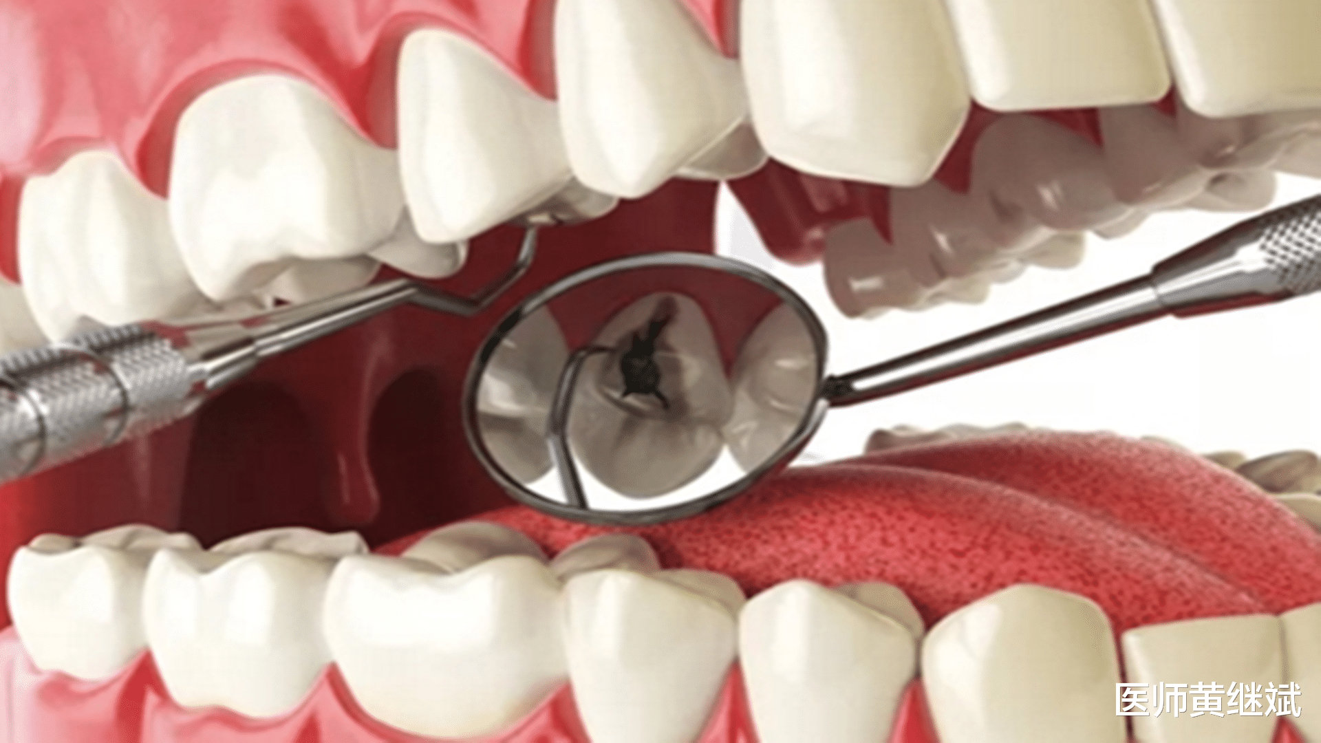 牙齿|烂牙时间长了不处理,自己掉了,这样可以吗?