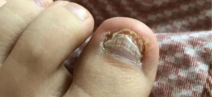 鸡胸肉 自用抑菌液测评分享！不愧是宝藏国货，短短45天新甲蹭蹭冒！