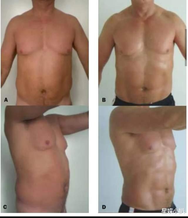 明星|肩膀打玻尿酸,腹肌靠手术,屁股靠垫,明星身上还有啥是真的?