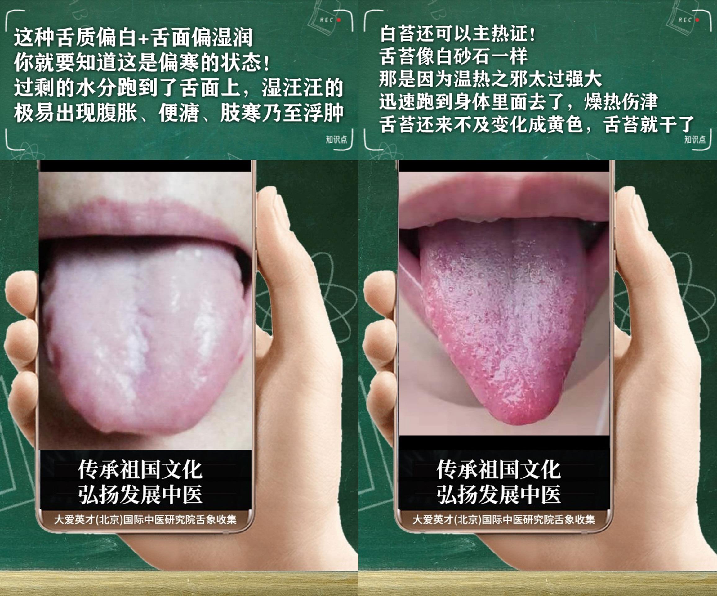 咳嗽|舌诊实例：常紧张、没有精神、经常咳嗽吐痰、一直未愈非常绝望