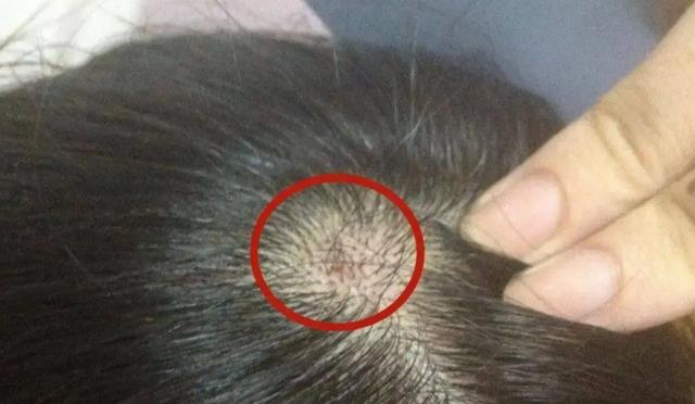 芡实|头皮总是长“疙瘩”和“脓包”,是咋回事?或是这3方面的原因