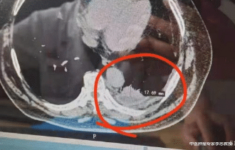 疾病|确诊了癌症,还有救吗?2个可能被你忽视的小细节,是治疗效果的关键