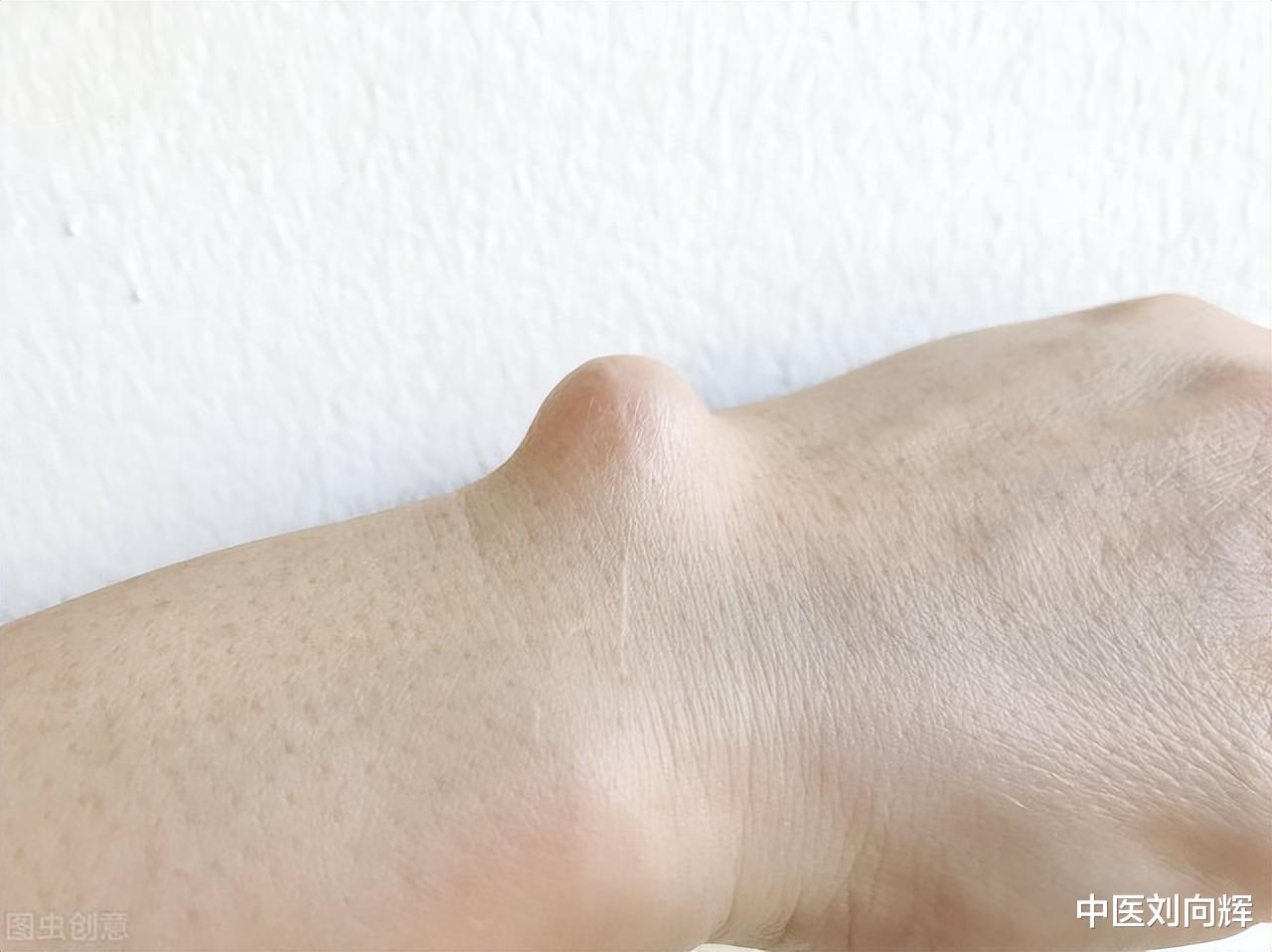 胃病|哪种舌像容易长息肉,结节,囊肿?刘医生教你如何用一味中药攻破