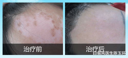 白癜风|白癜风要消失往往会出现5个迹象,对照起来,看看你身上是否出现过吧!