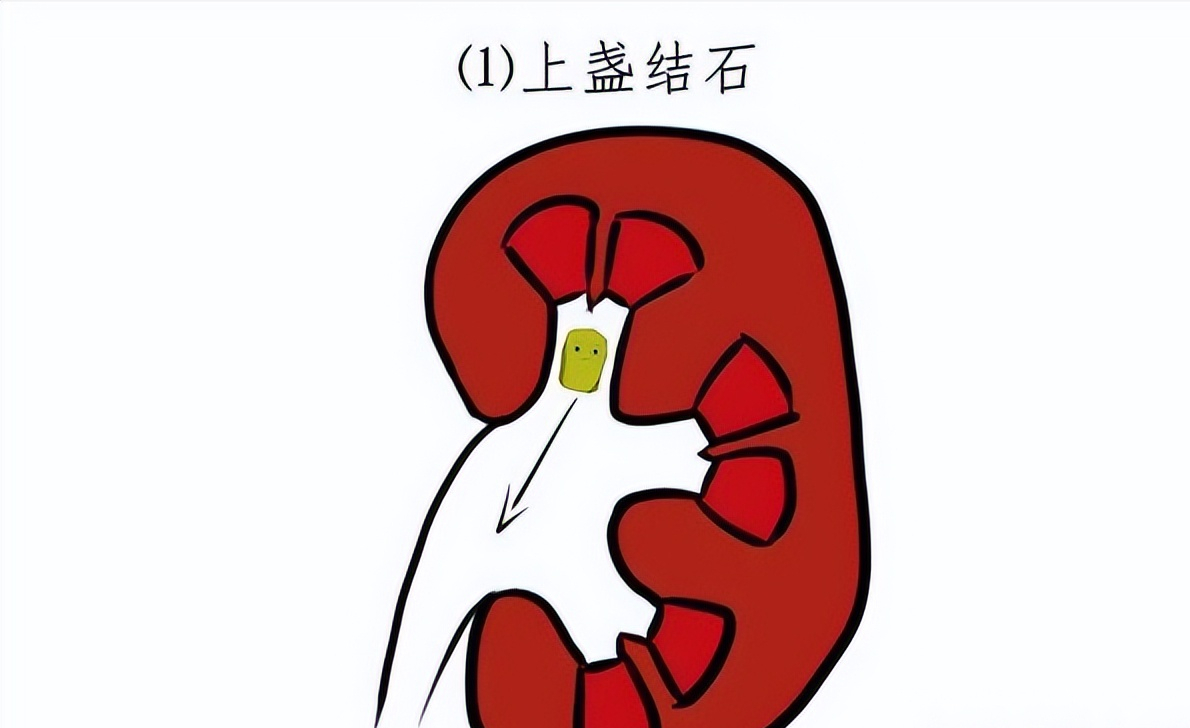 椰子|坐过山车、跳绳、喝水，肾结石到底怎么排？还是这个方法最适合人使用。