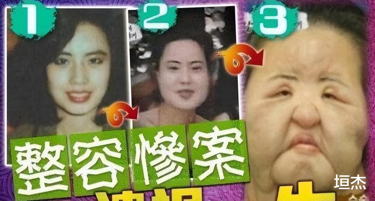 刘晓庆|刘晓庆拉皮多次耳粘脸，郎朗前女友变成锥子精，整容后遗症太可怕