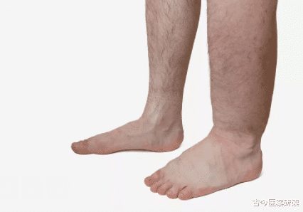 尿酸|数名专家呼吁:停止食用“1白2绿”,或是肾衰的“诱发剂”,趁早远离