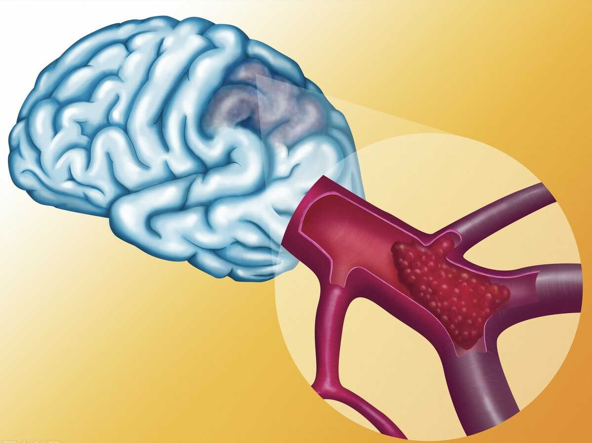 心房颤动|房颤患者预防脑梗,常用4个新型抗凝药,无须监测凝血,药效稳定