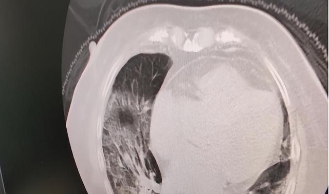 水果|新冠“老旧株”在我国“复出”？专家谈3个真相