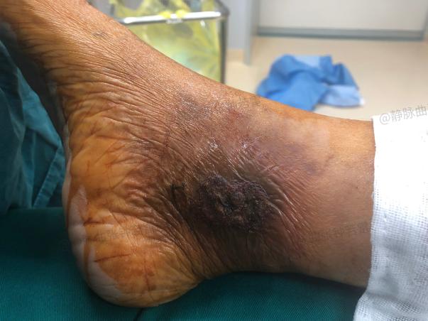 穿孔|小腿反复痒和溃疡怎么办?
