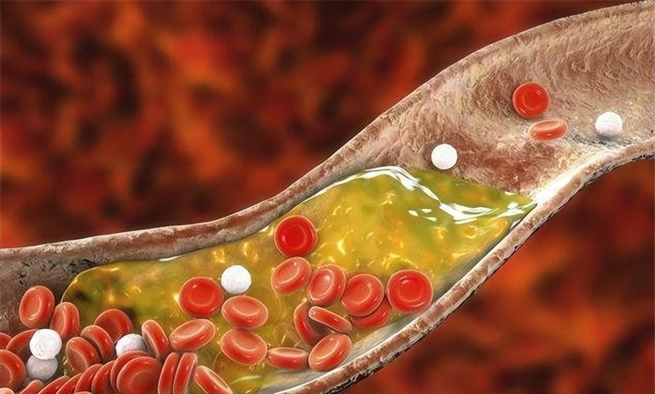 肾衰竭|58岁张叔查出慢性肾衰竭,原因:擅自将辛伐他汀换成瑞舒伐他汀