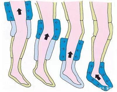 静脉曲张|静脉曲张不可怕!“直击灵魂”三大问:找对人、管住嘴、迈开腿?