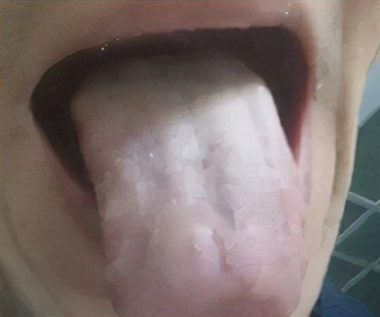 胆囊|从舌苔看健康,跟中医学舌诊,这6种要注意!(中医小白篇)