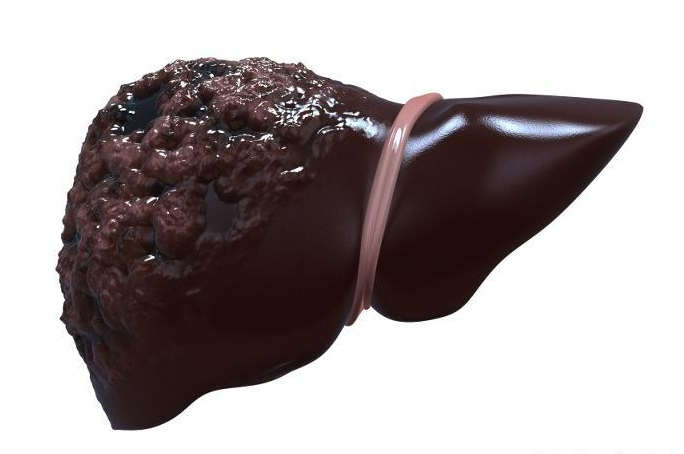 高血压|肝癌虽然可怕，但掌握了4个好方法，它就进不了你的门