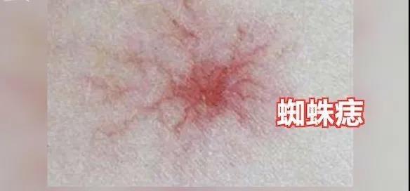 便秘|手脚出现这4种问题,可能与癌症有关,别不当回事